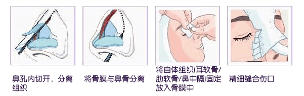 隆鼻手术方法