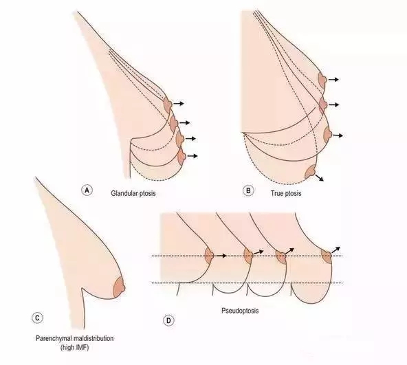 上海乳房下垂矫正效果怎么样