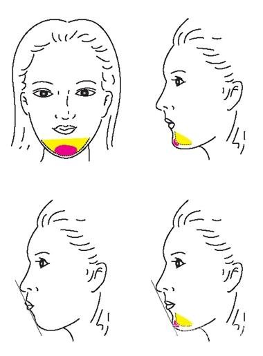 丰下巴用什么材料比较好